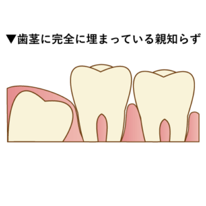 歯茎に完全に埋まっている親知らず