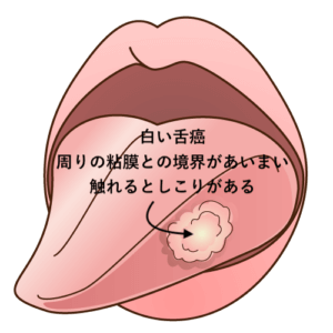 白い舌癌