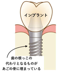 インプラント