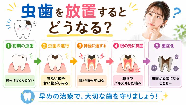 虫歯を放置するとどうなる？の図解