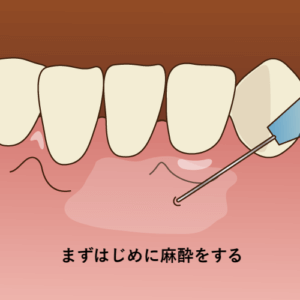 まずはじめに麻酔をする