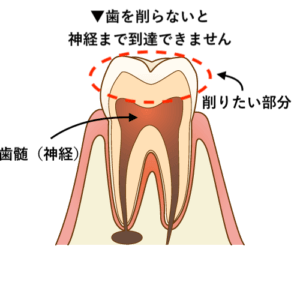 根管治療のためにまず歯を削る