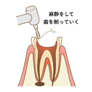 麻酔をして歯を削る
