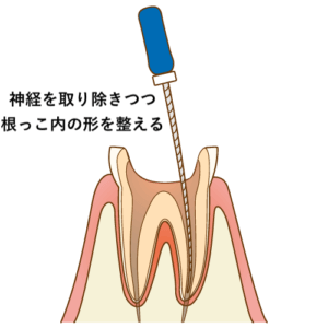 神経を取る治療