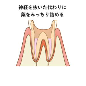 虫歯治療のうち神経の治療方法 流れまとめ 歯科衛生士がお口の悩みに答えます