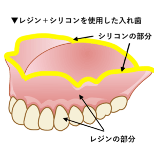 レジンとシリコンを使用した入れ歯