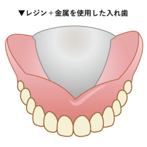 金属床の入れ歯