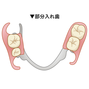 部分入れ歯