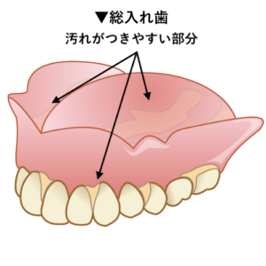 総入れ歯の汚れやすい部分