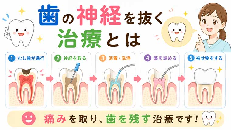 歯の神経を抜く治療とはの図解