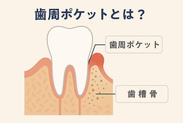歯周ポケットとは?