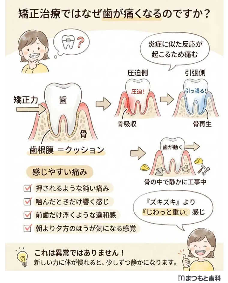 【図解】矯正治療ではなぜ歯が痛くなるのですか？