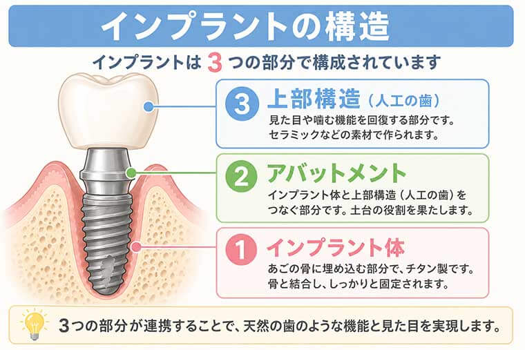 インプラントの構造の図解