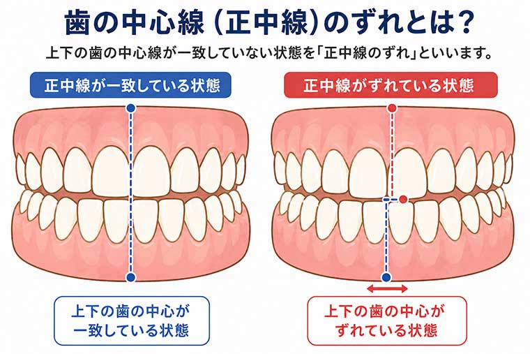 歯の中心のずれの図解