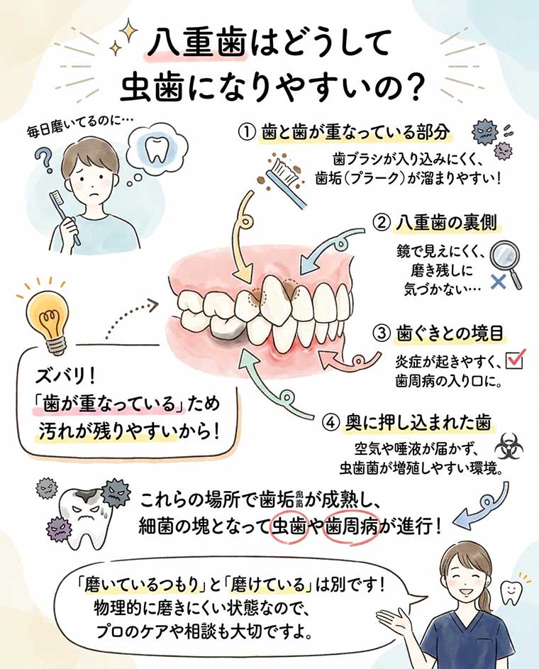 八重歯はどうして虫歯になりやすいの？の図解